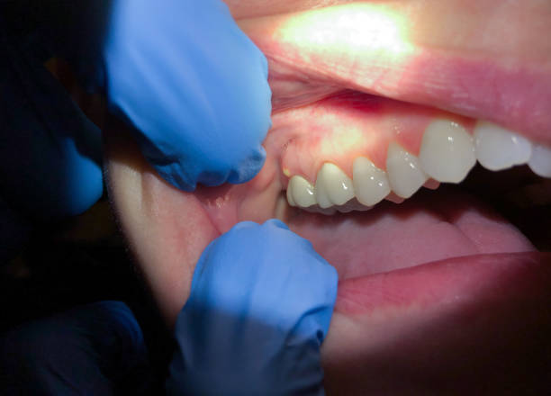 Best Emergency Treatment for Dental Infections or Abscesses in Hooverson Heights, WV
